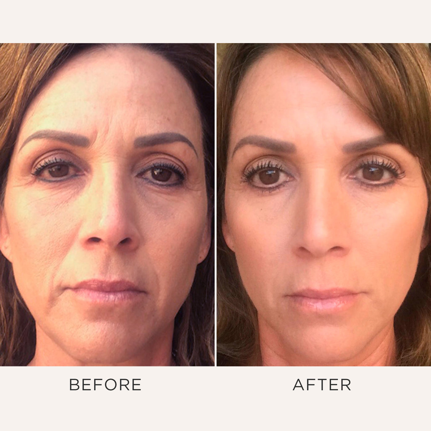 Before and after comparison of a woman's face with visible skin changes.