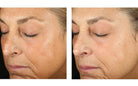 Before and after comparison of a woman's face showing skin texture changes.